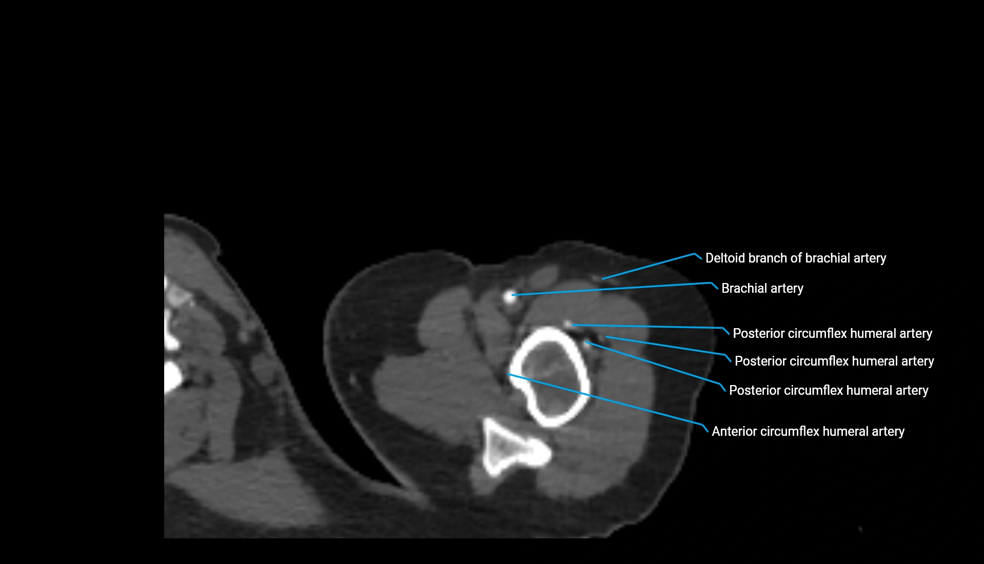 CTA upper limb axial cross sectional anatomy labelled image 313 (1).webp
